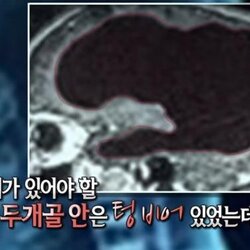 두개골 안은 텅비어 있었는데 뇌가 있어야할 자리에 뇌가 없어 무뇌 생각이 없다